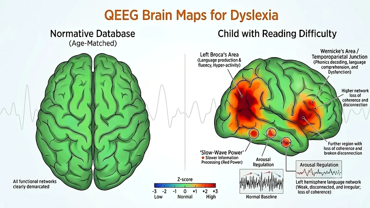 A QEEG brain map comparing a child's reading-network activity to an age-matched normative database