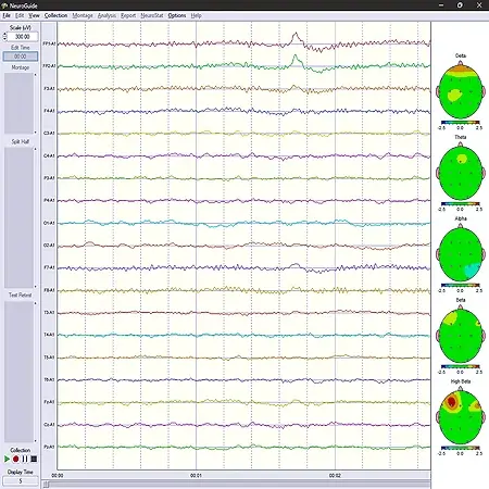 NeuroGuide EEG Traces