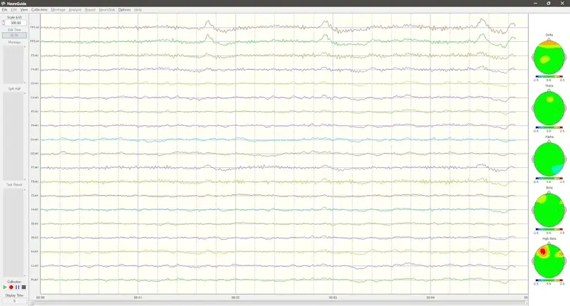การบันทึก EEG 19 ช่อง พร้อมแผนที่สมอง QEEG สำหรับคลื่นเดลตา ทีตา อัลฟา เบตา และไฮเบตา